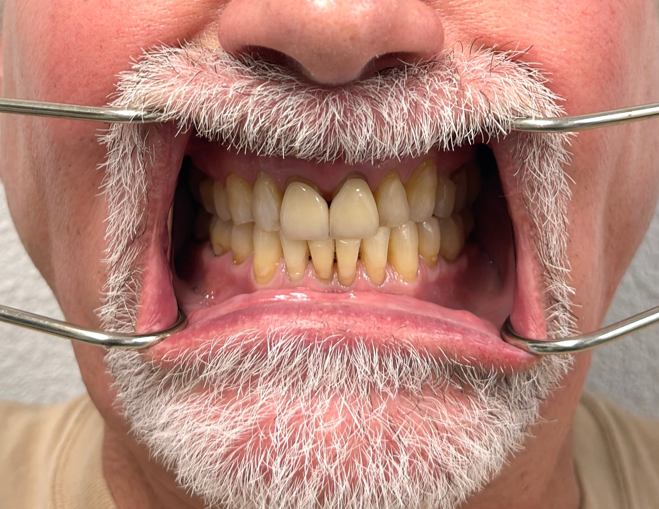 Patient smile before 3D printed veneers treatment
