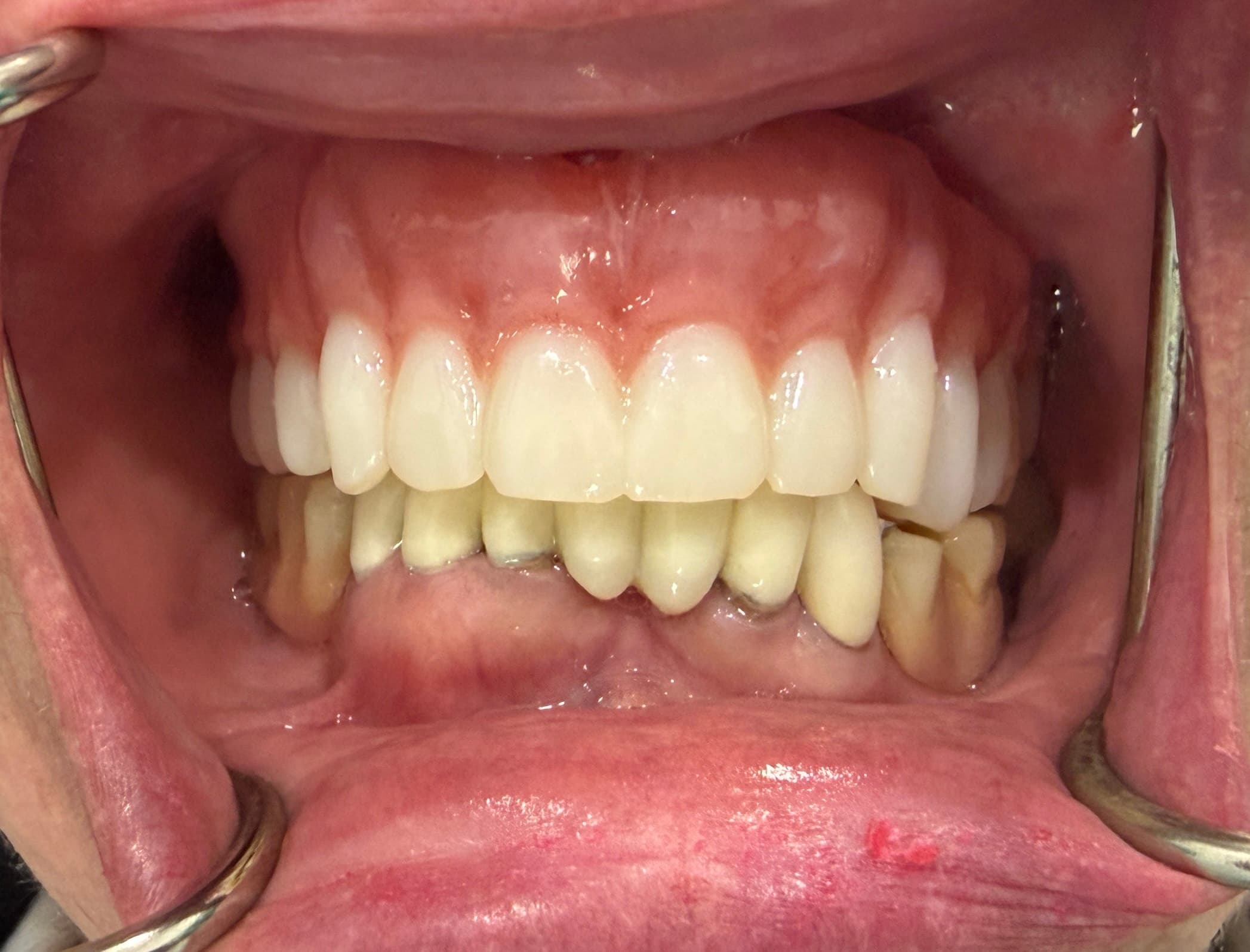 Patient smile after 3D printed dentures