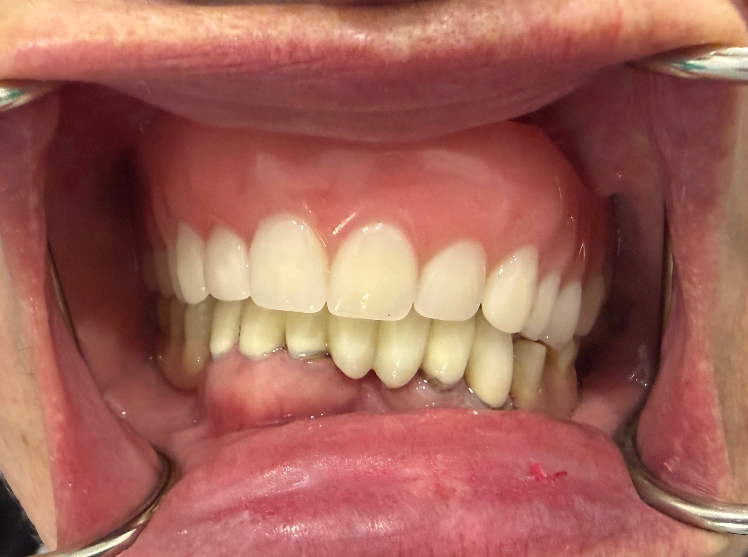 Patient smile before 3D printed dentures